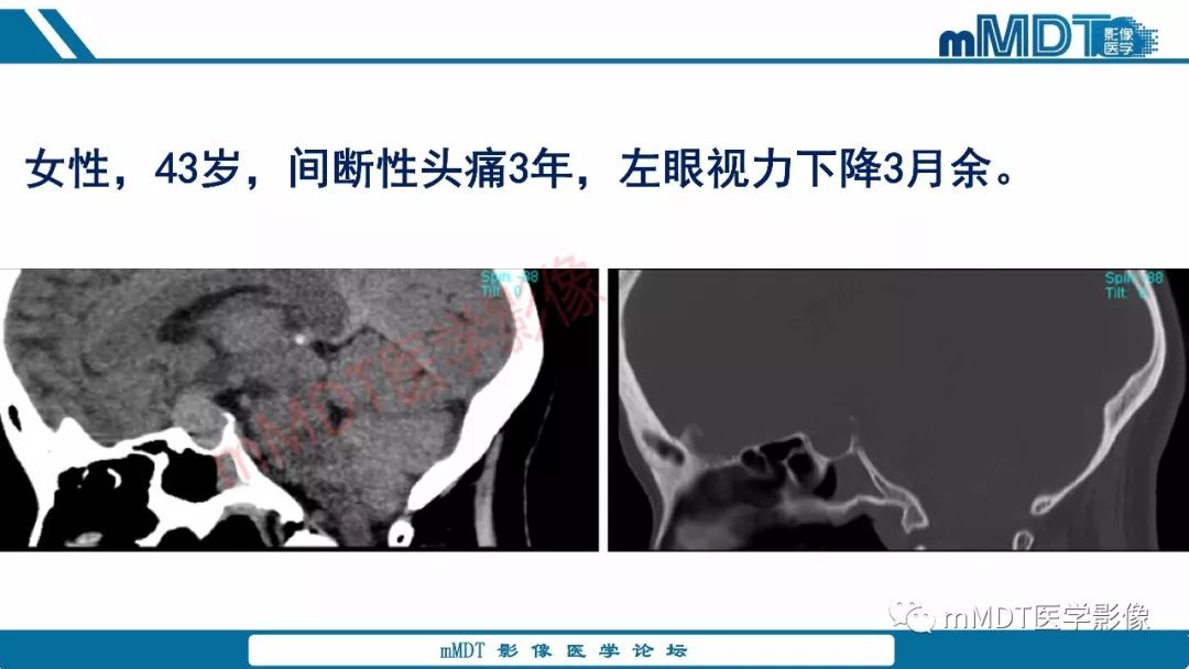 【PPT】蝶鞍、鞍上少见实性肿瘤影像表现及鉴别诊断