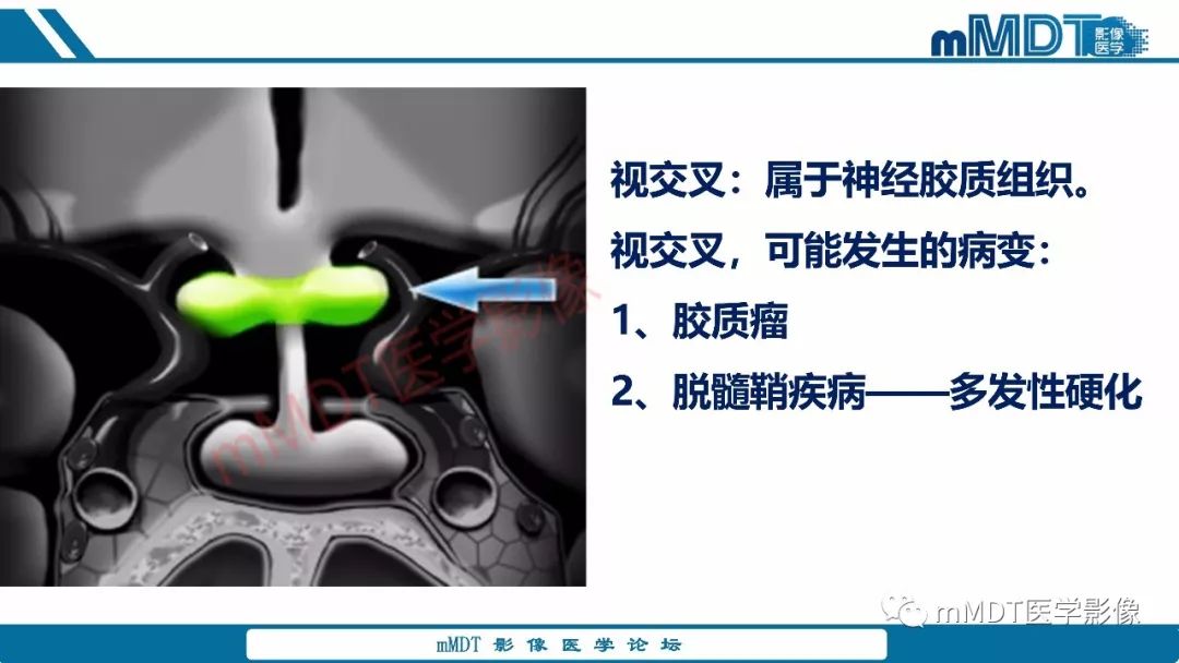 【PPT】蝶鞍、鞍上少见实性肿瘤影像表现及鉴别诊断