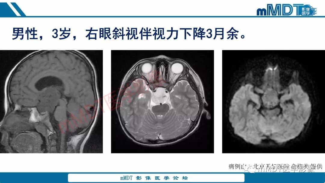 【PPT】蝶鞍、鞍上少见实性肿瘤影像表现及鉴别诊断