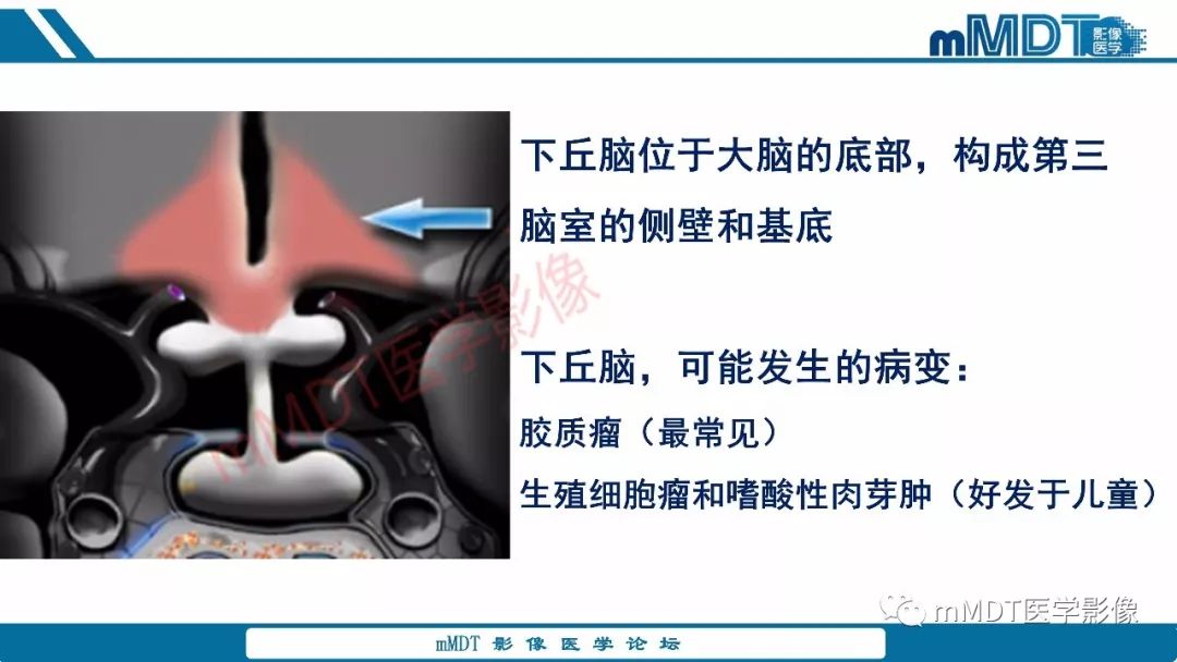 【PPT】蝶鞍、鞍上少见实性肿瘤影像表现及鉴别诊断