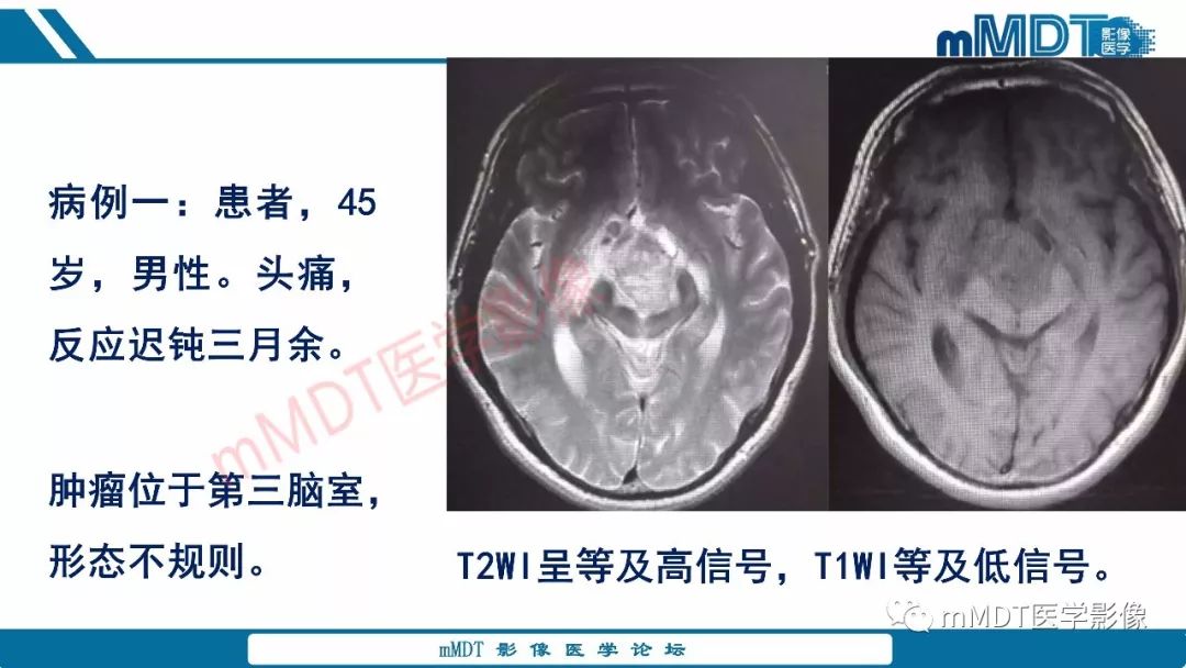【PPT】蝶鞍、鞍上少见实性肿瘤影像表现及鉴别诊断