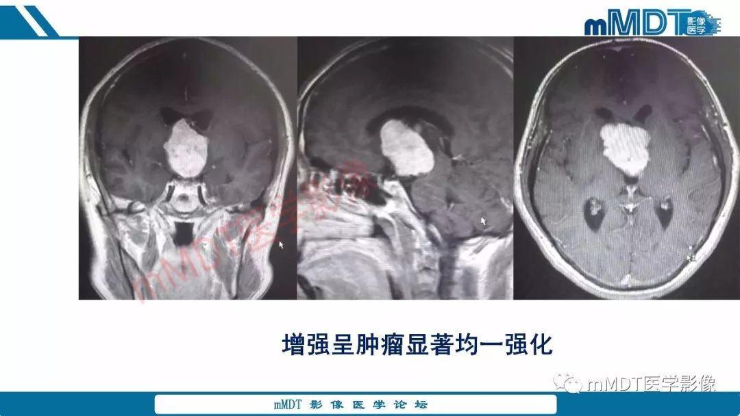 【PPT】蝶鞍、鞍上少见实性肿瘤影像表现及鉴别诊断
