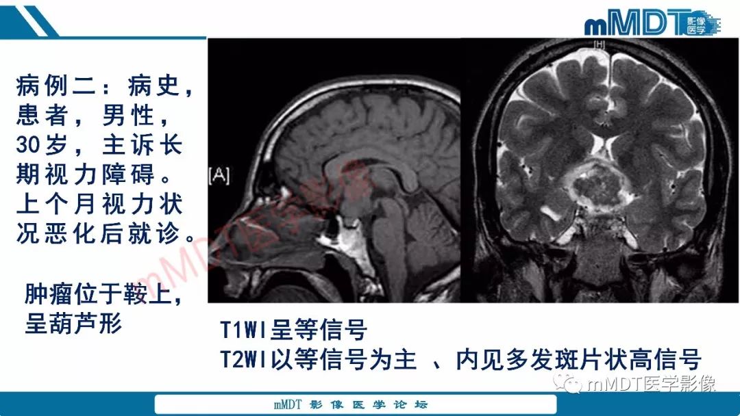 【PPT】蝶鞍、鞍上少见实性肿瘤影像表现及鉴别诊断