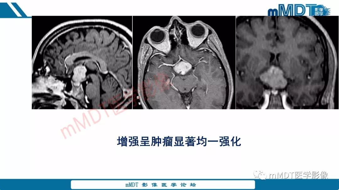 【PPT】蝶鞍、鞍上少见实性肿瘤影像表现及鉴别诊断