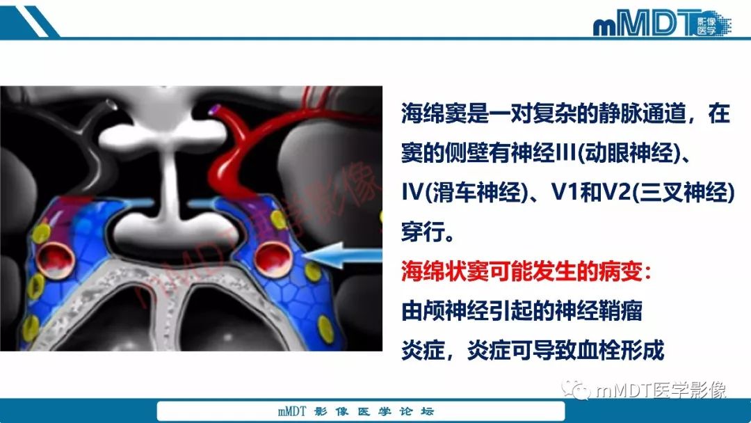 【PPT】蝶鞍、鞍上少见实性肿瘤影像表现及鉴别诊断
