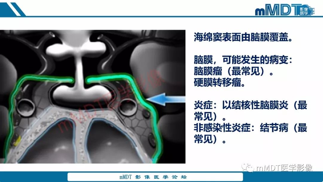 【PPT】蝶鞍、鞍上少见实性肿瘤影像表现及鉴别诊断