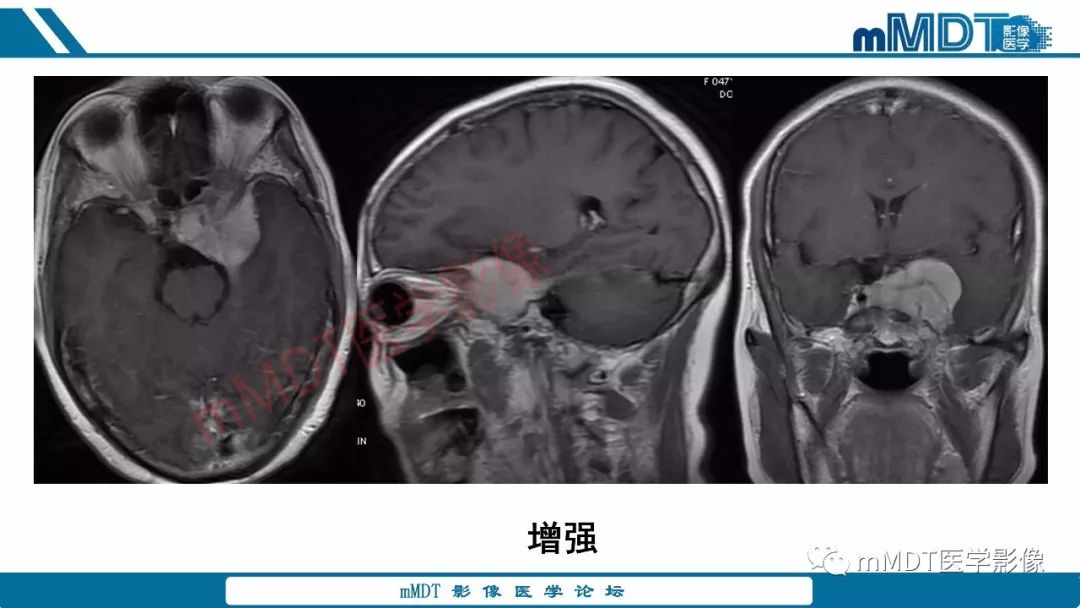 【PPT】蝶鞍、鞍上少见实性肿瘤影像表现及鉴别诊断