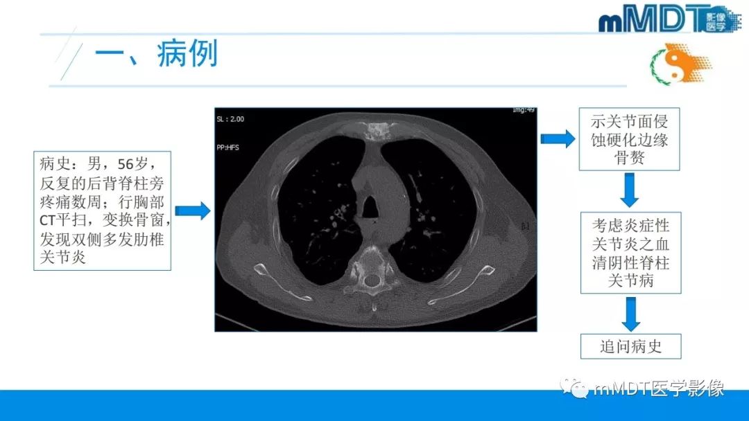 【PPT】肠病性关节炎的影像表现