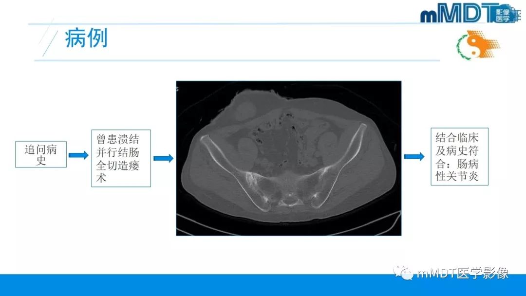 【PPT】肠病性关节炎的影像表现
