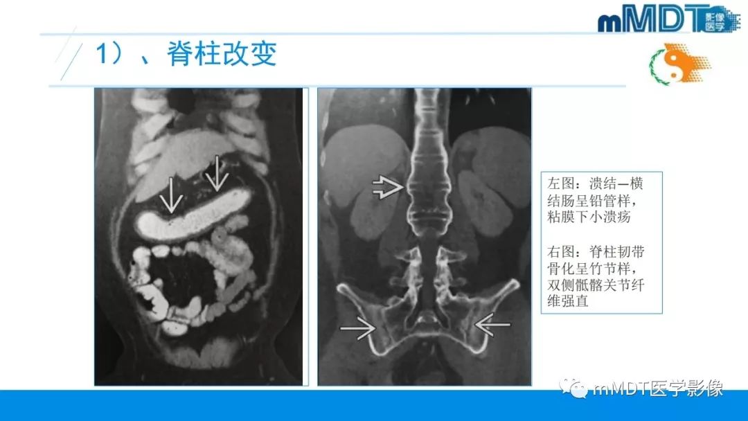 【PPT】肠病性关节炎的影像表现