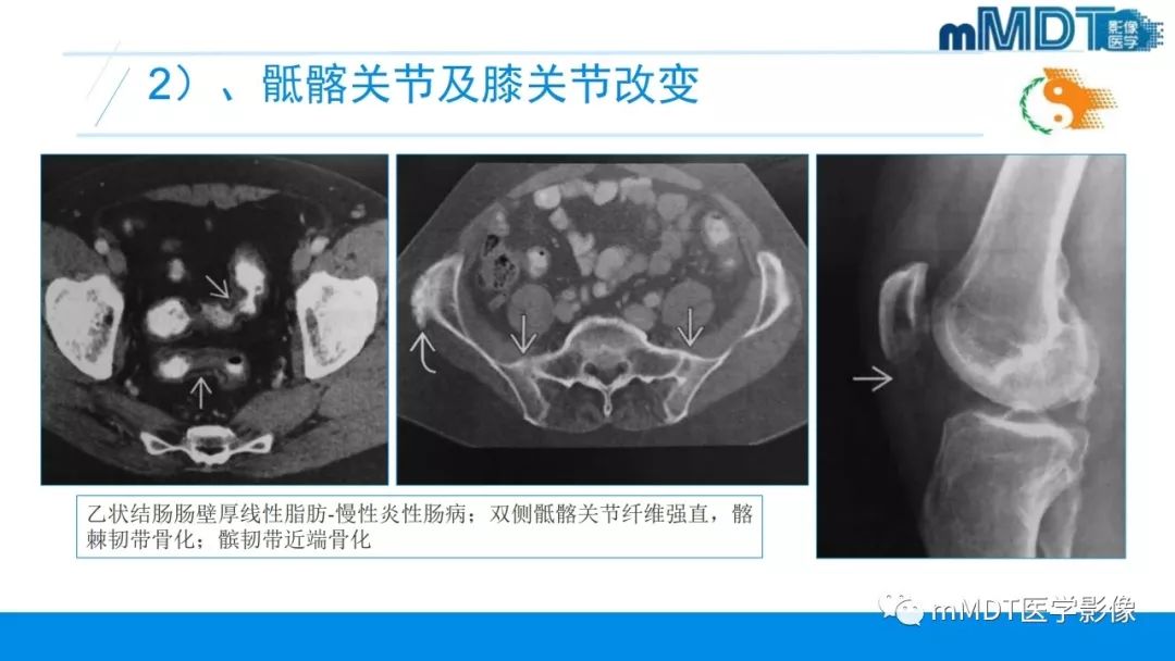 【PPT】肠病性关节炎的影像表现