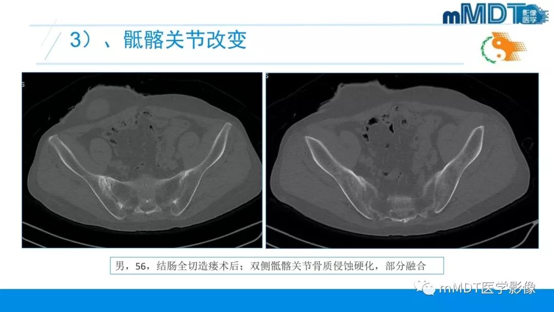 【PPT】肠病性关节炎的影像表现