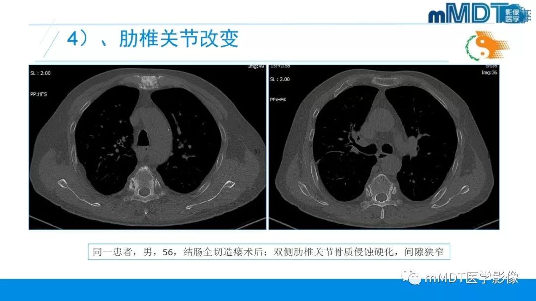 【PPT】肠病性关节炎的影像表现