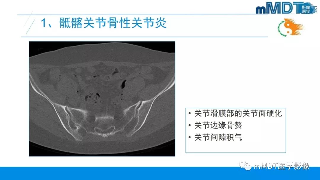 【PPT】肠病性关节炎的影像表现
