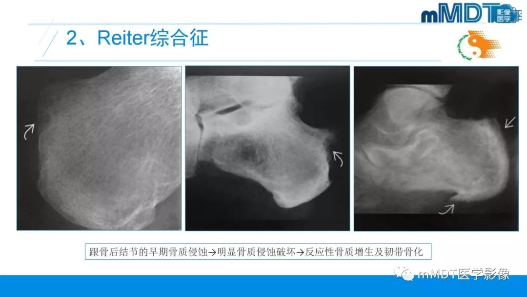 【PPT】肠病性关节炎的影像表现