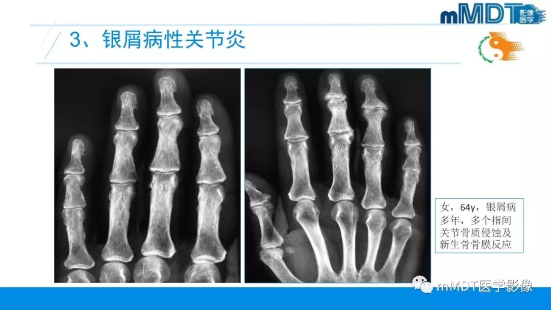 【PPT】肠病性关节炎的影像表现
