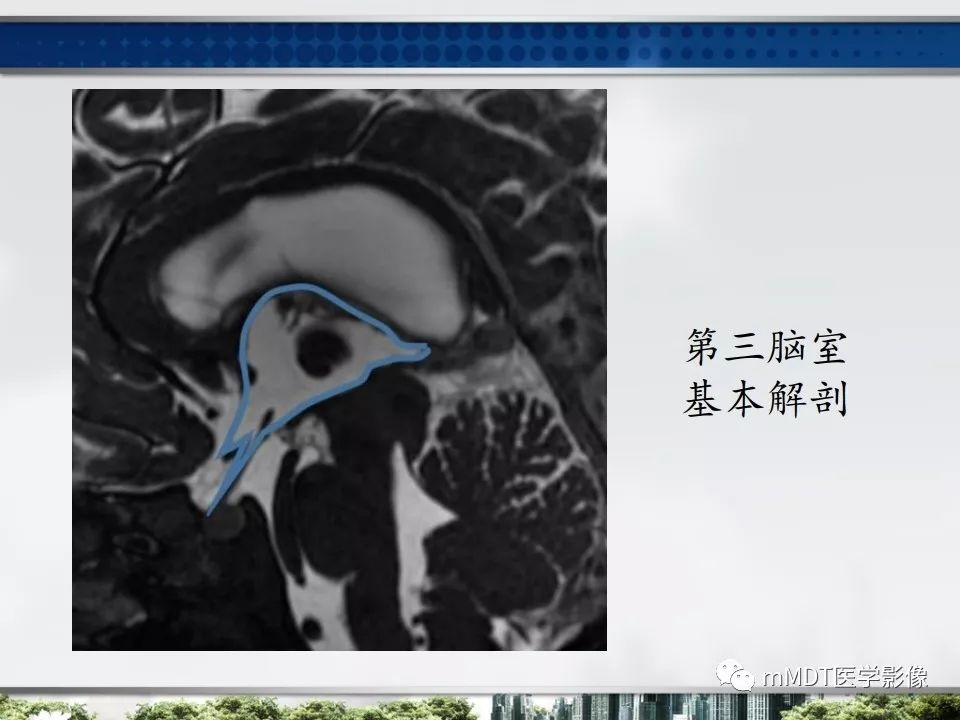 【PPT】三脑室肿瘤影像诊断与鉴别诊断