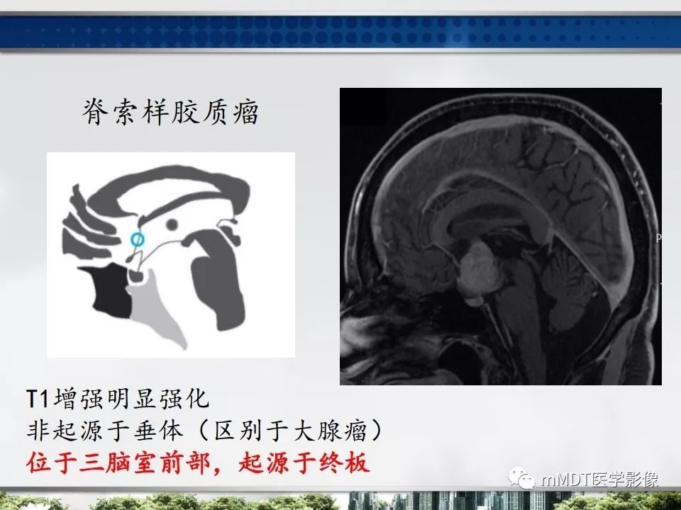 【PPT】三脑室肿瘤影像诊断与鉴别诊断
