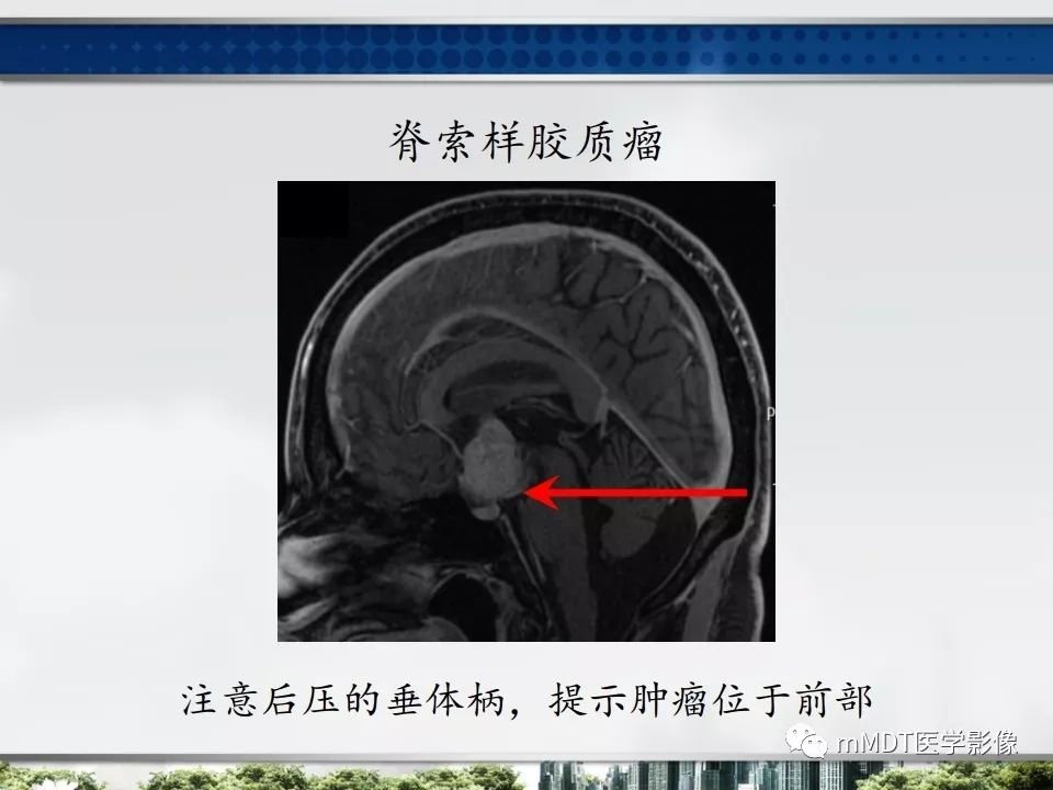 【PPT】三脑室肿瘤影像诊断与鉴别诊断