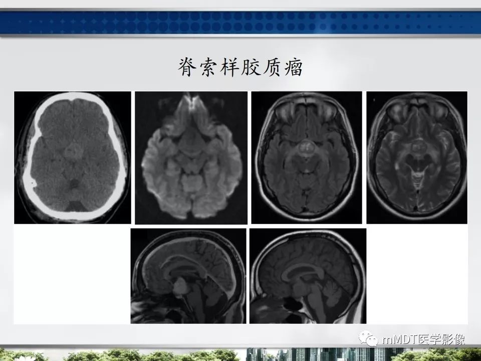 【PPT】三脑室肿瘤影像诊断与鉴别诊断