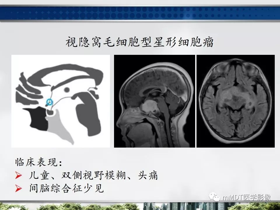 【PPT】三脑室肿瘤影像诊断与鉴别诊断