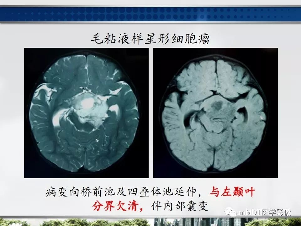 【PPT】三脑室肿瘤影像诊断与鉴别诊断