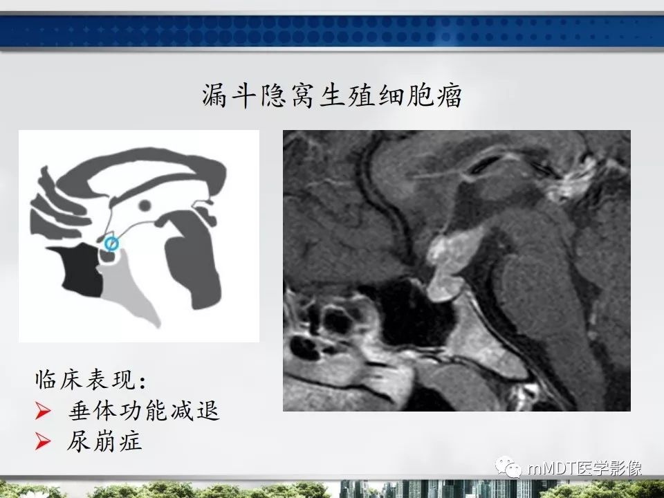【PPT】三脑室肿瘤影像诊断与鉴别诊断