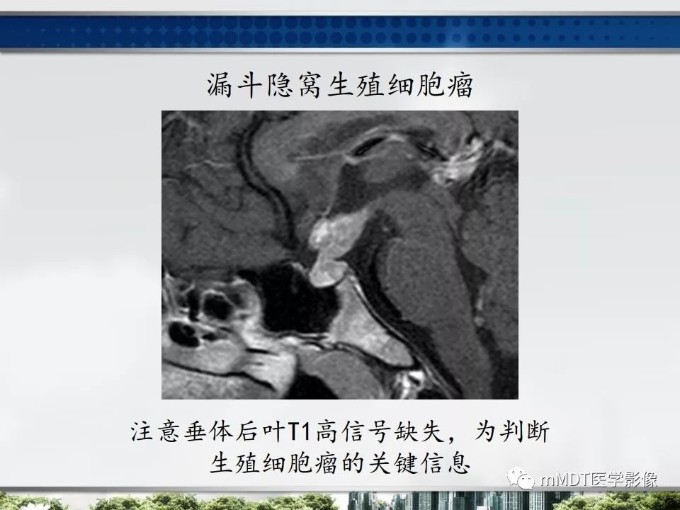【PPT】三脑室肿瘤影像诊断与鉴别诊断