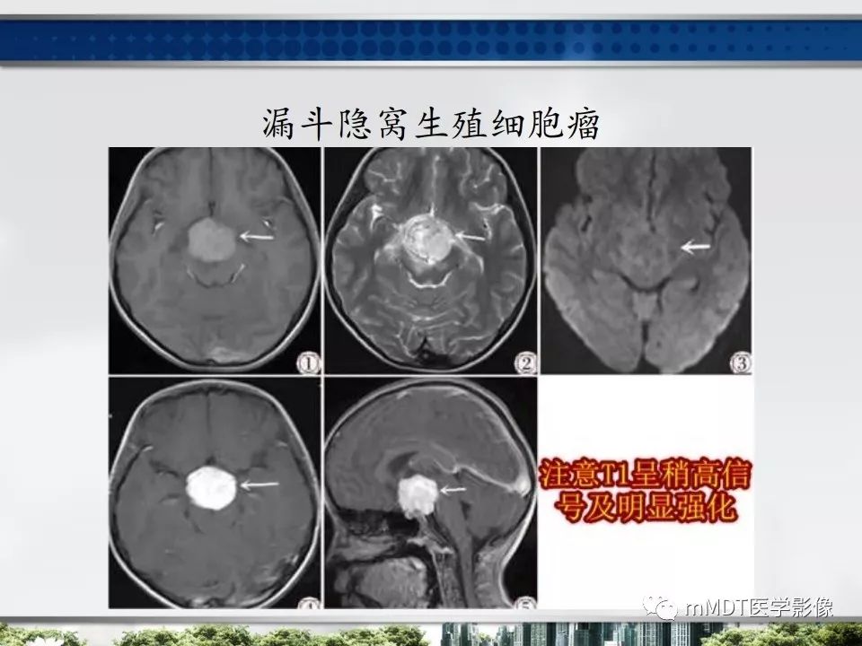 【PPT】三脑室肿瘤影像诊断与鉴别诊断