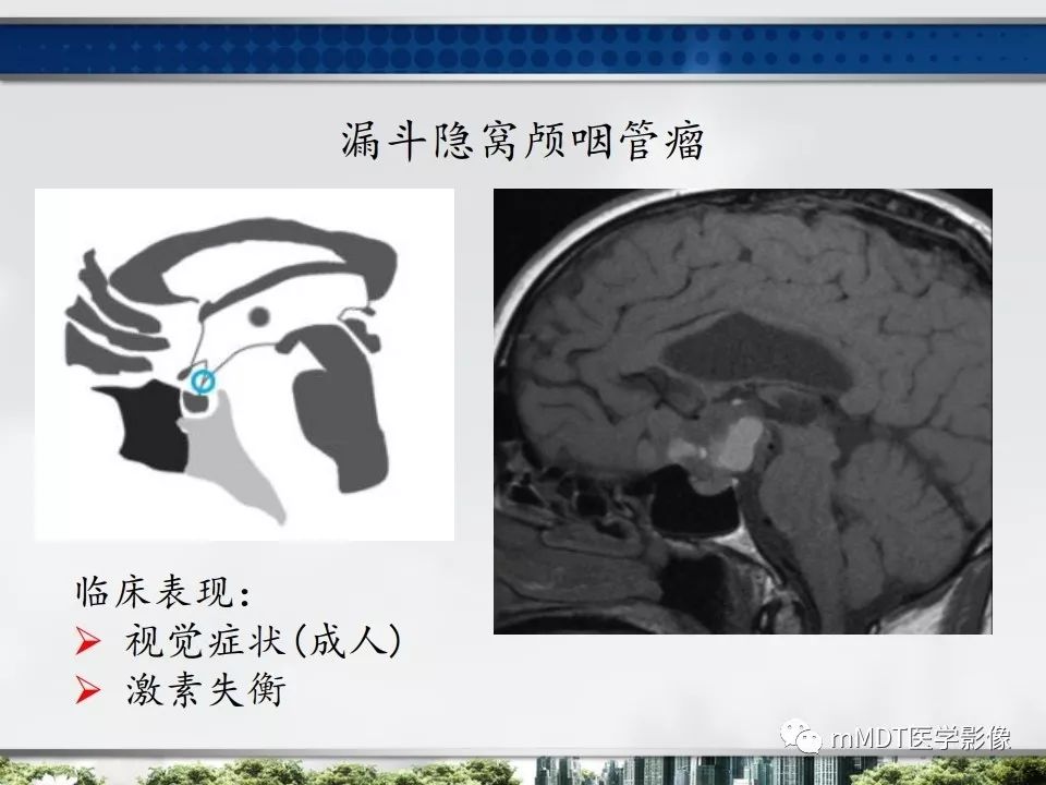 【PPT】三脑室肿瘤影像诊断与鉴别诊断