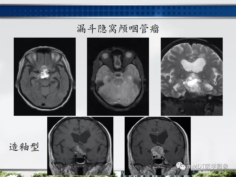 【PPT】三脑室肿瘤影像诊断与鉴别诊断