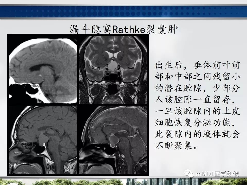 【PPT】三脑室肿瘤影像诊断与鉴别诊断