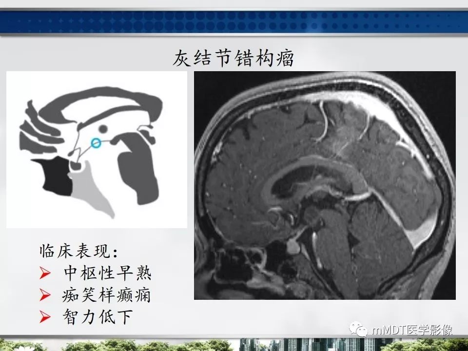【PPT】三脑室肿瘤影像诊断与鉴别诊断