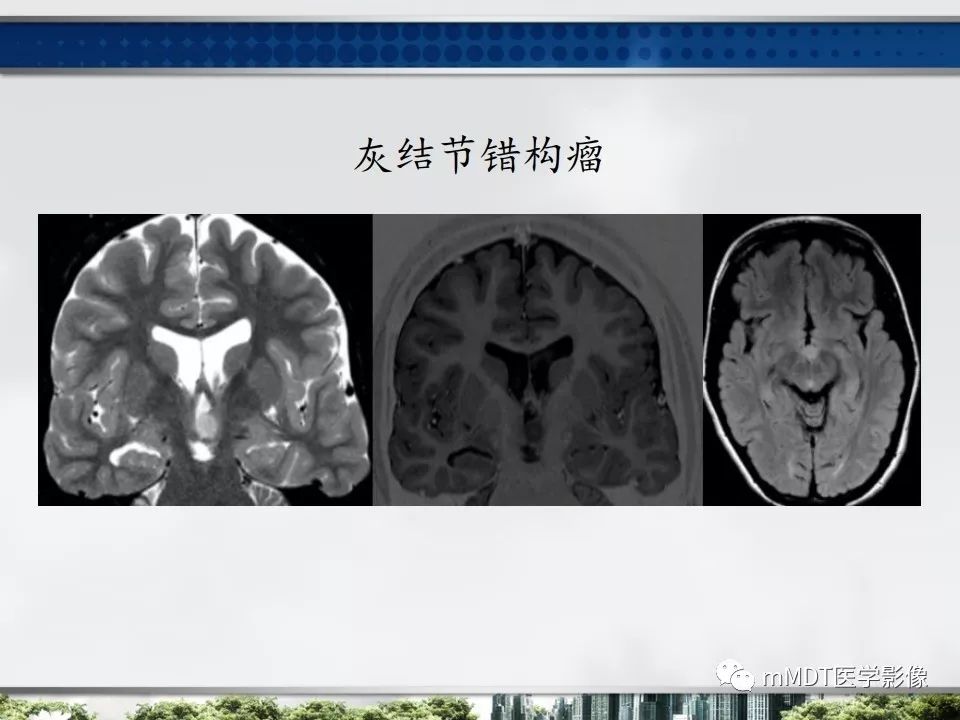 【PPT】三脑室肿瘤影像诊断与鉴别诊断