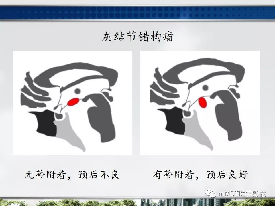 【PPT】三脑室肿瘤影像诊断与鉴别诊断