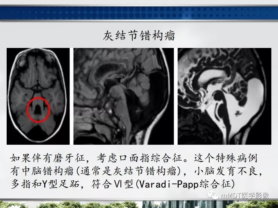【PPT】三脑室肿瘤影像诊断与鉴别诊断
