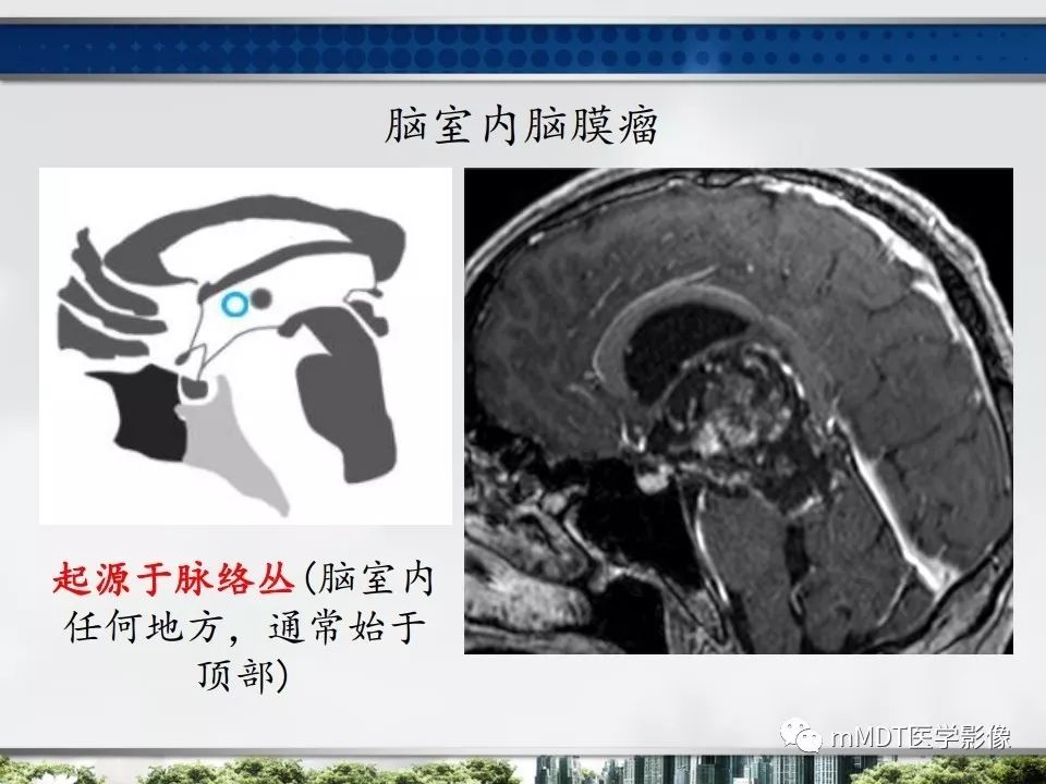 【PPT】三脑室肿瘤影像诊断与鉴别诊断