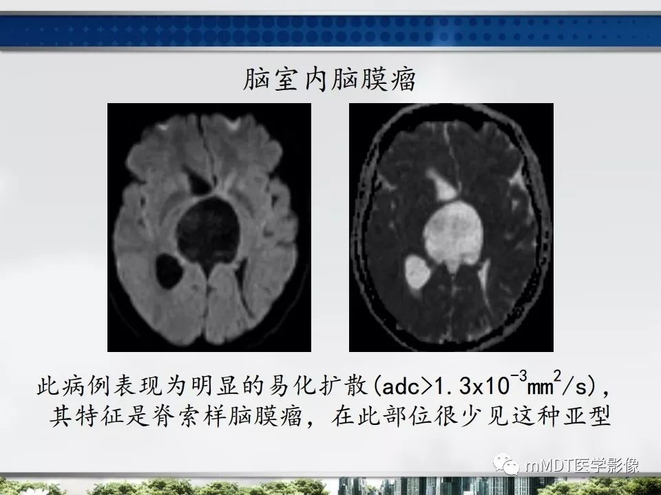 【PPT】三脑室肿瘤影像诊断与鉴别诊断