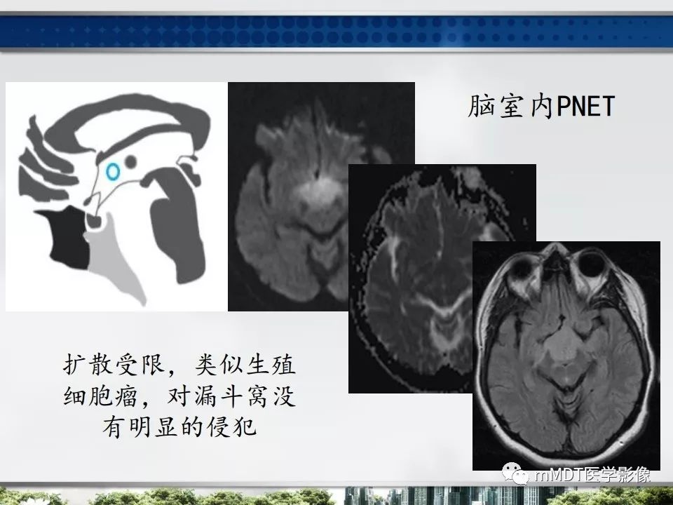 【PPT】三脑室肿瘤影像诊断与鉴别诊断