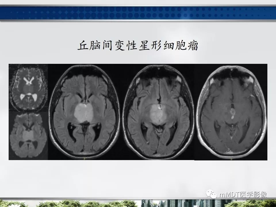 【PPT】三脑室肿瘤影像诊断与鉴别诊断