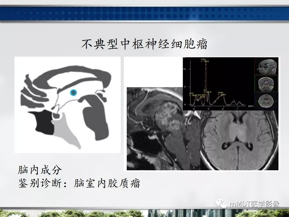 【PPT】三脑室肿瘤影像诊断与鉴别诊断