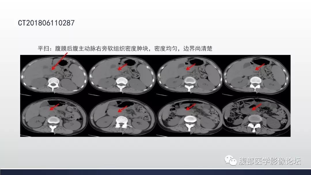 【病例】腹膜后巨淋巴结增生症1例CT影像表现 【病例】腹膜后巨淋巴结增生症1例CT影像表现