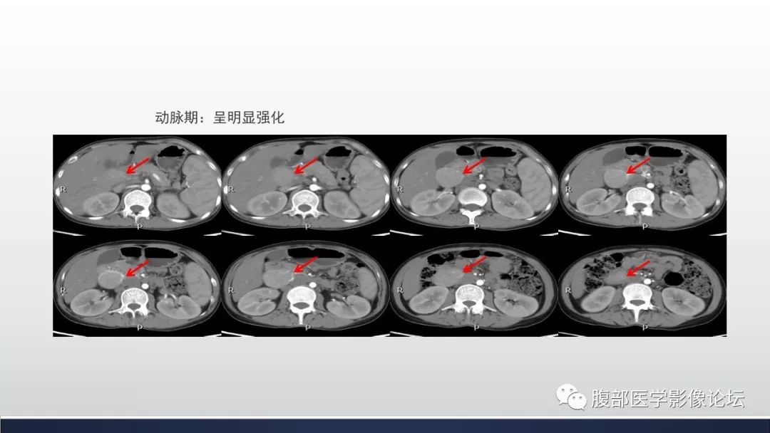 【病例】腹膜后巨淋巴结增生症1例CT影像表现 【病例】腹膜后巨淋巴结增生症1例CT影像表现