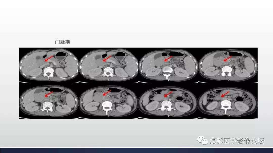 【病例】腹膜后巨淋巴结增生症1例CT影像表现 【病例】腹膜后巨淋巴结增生症1例CT影像表现