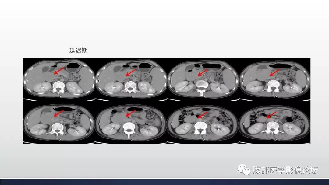 【病例】腹膜后巨淋巴结增生症1例CT影像表现 【病例】腹膜后巨淋巴结增生症1例CT影像表现