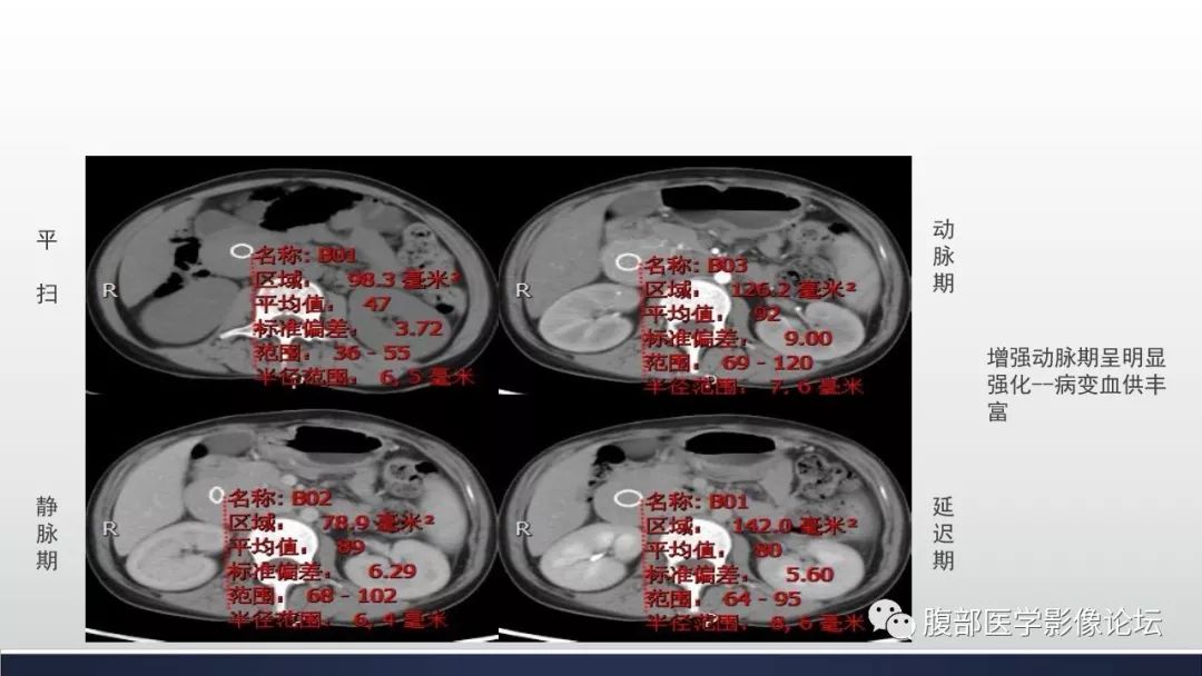 【病例】腹膜后巨淋巴结增生症1例CT影像表现 【病例】腹膜后巨淋巴结增生症1例CT影像表现