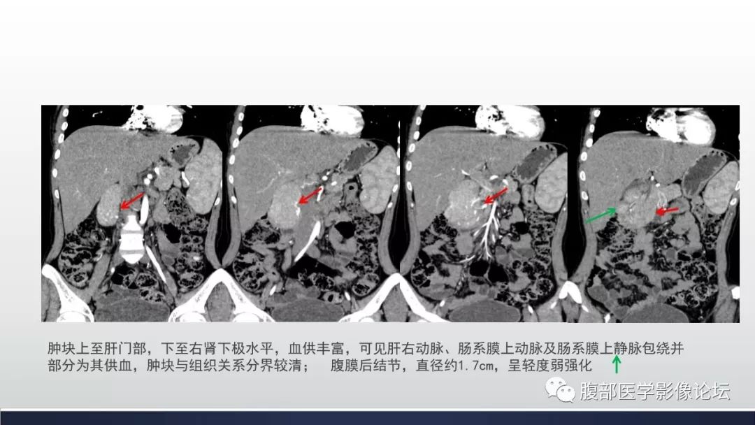 【病例】腹膜后巨淋巴结增生症1例CT影像表现 【病例】腹膜后巨淋巴结增生症1例CT影像表现