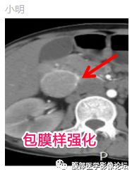 【病例】腹膜后巨淋巴结增生症1例CT影像表现 【病例】腹膜后巨淋巴结增生症1例CT影像表现