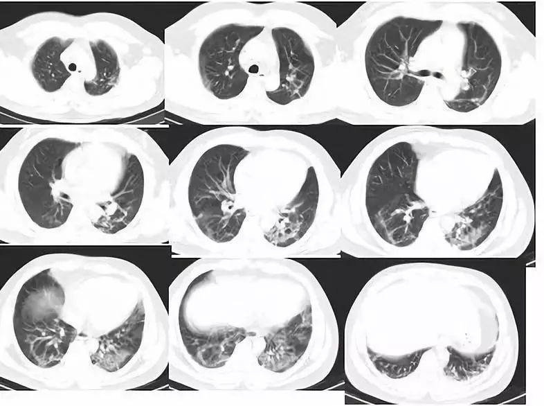 【病例】百草枯中毒肺部影像表现3例 【病例】百草枯中毒肺部影像表现3例