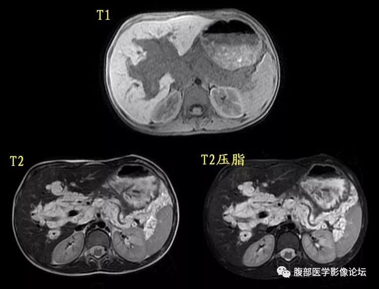【病例】丛状神经纤维瘤病1例CT及MR